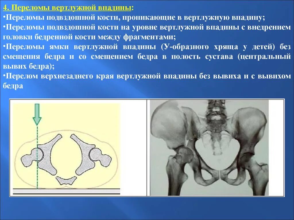 Образование подвздошной кости. Вертлужная впадина тазобедренного сустава перелом. Перелом кости вертлужной впадины. Перелом таза вертлужной впадины. Кости таза перелом вертлужной впадины.