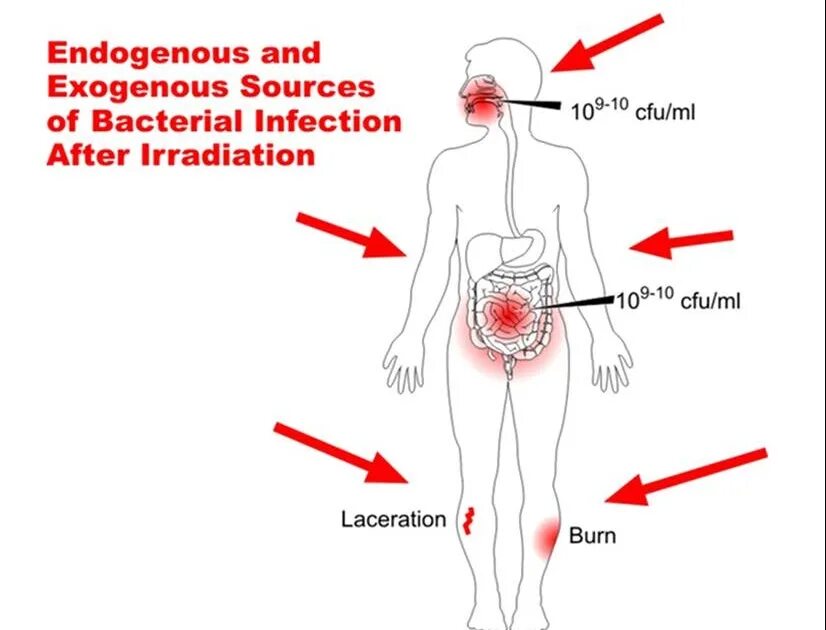 Infection. Exogenous infection. The source of infection exogenous and endogenous. Exogenous and endogenous infection classification.