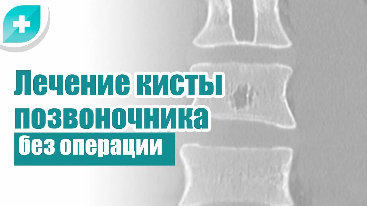 Киста в позвоночнике лечение. Лекарства от кисты на позвоночнике. Киста позвоночника операция. Периартикулярная киста позвоночника. Операция кисты позвоночника