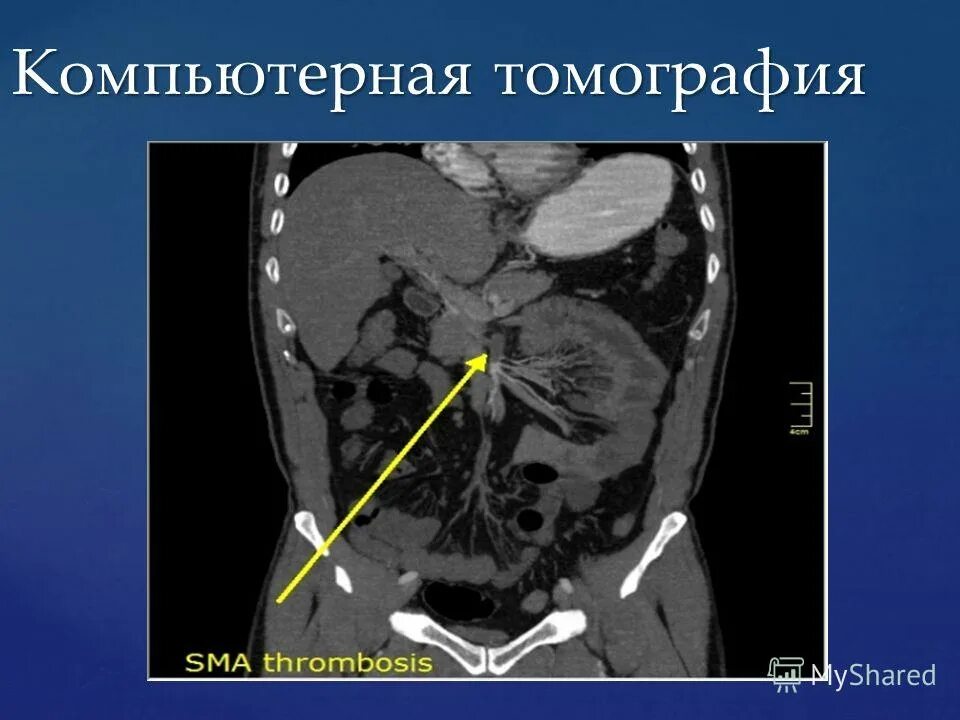 Мезентериальная ишемия кишечника. Ишемия толстой кишки кт. Хроническая ишемия органов пищеварения. Верхняя брыжеечная артерия кт. Язва кт