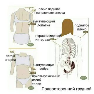 Сколиоз позвоночника симптомы