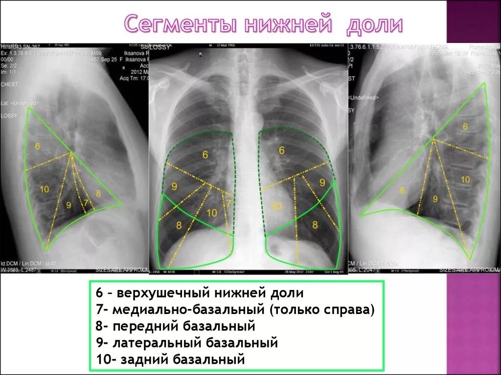 6, 10 Сегмент правого легкого. S9 сегмент левого легкого. S8 левого легкого