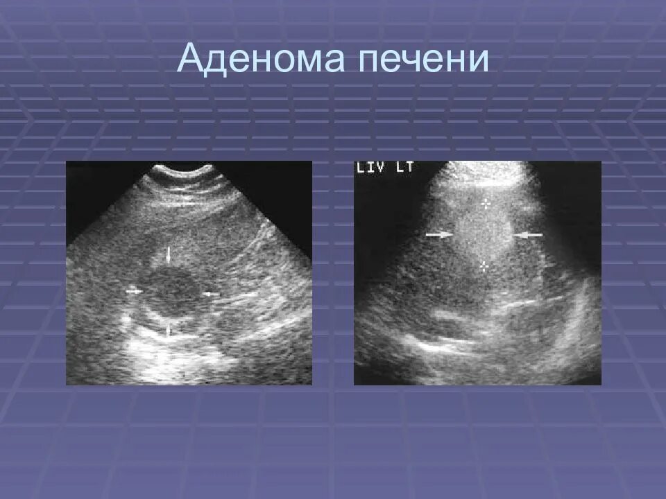 Доброкачественное образование печени. Гепатоцеллюлярная аденома УЗИ. Доброкачественные образования печени на УЗИ. Новообразование в печени на УЗИ.