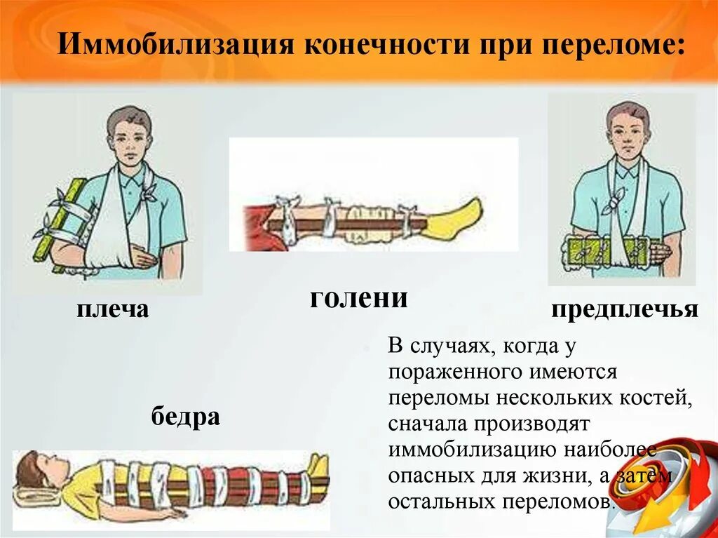 Правила при открытом переломе. Иммобилизация конечности при переломе. Транспортная иммобилизация конечности предплечья. Иммобилизация при переломе плечевой кости осуществляется. Иммобилизация конечности при переломе костей.