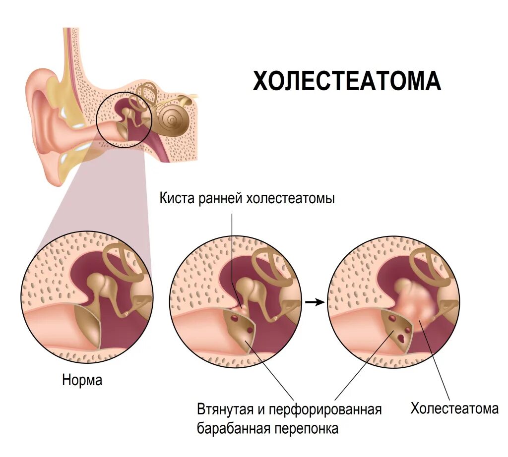 What are the signs of a perforated eardrum in a child? Vinmec