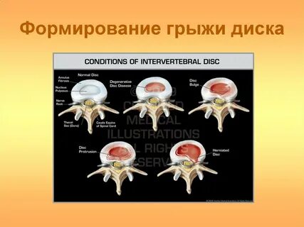 Грыжи дисков размеры
