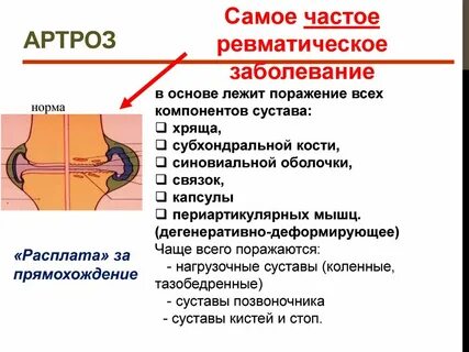 Артрит суставов кисти мкб 10
