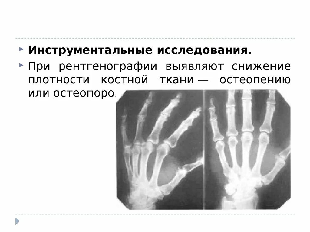 Нарушение плотности костей. Повышение плотности костной ткани на рентгене. рентген плотности кости. остеопения рентген. снижение костной плотности.