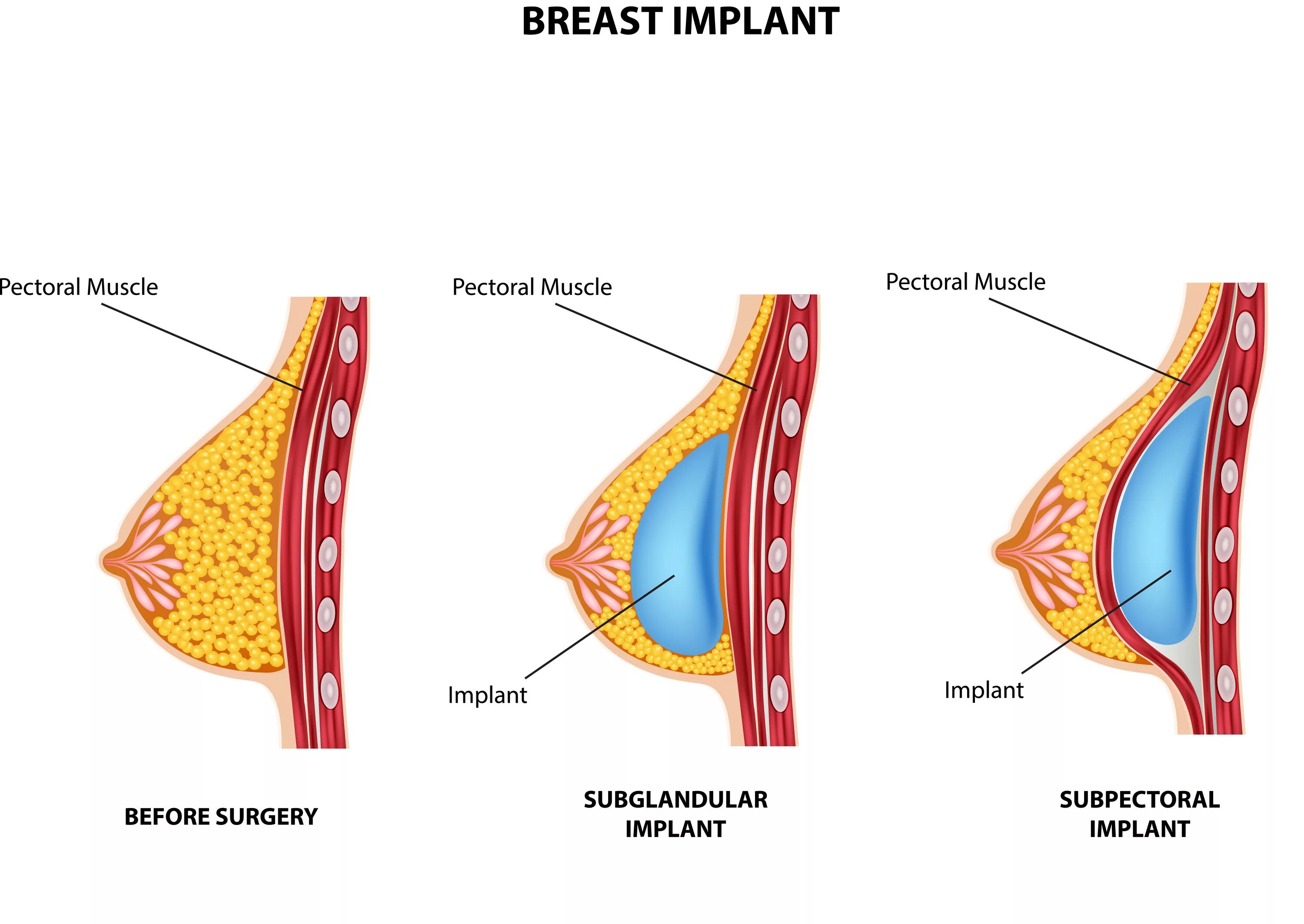 Импланты грудных желез. Имплант под грудную мышцу. Имплант под молочную железу. Импланты груди под мышцу.