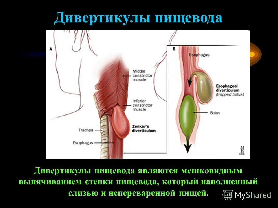 дивертикул ценкера рентгеноскопия. тракционный дивертикул пищевода. врожденный дивертикул пищевода. дивертикул пищевода рентген. дивертикул ценкера классификации.