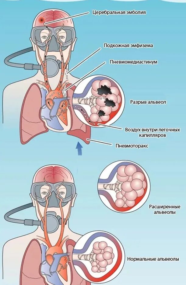 Газовая эмболия кессонная болезнь. Газовая эмболия при кессонной болезни. Кессонная болезнь воздушная эмболия. Баротравматическая газовая эмболия. Баротравма это простыми словами в медицине