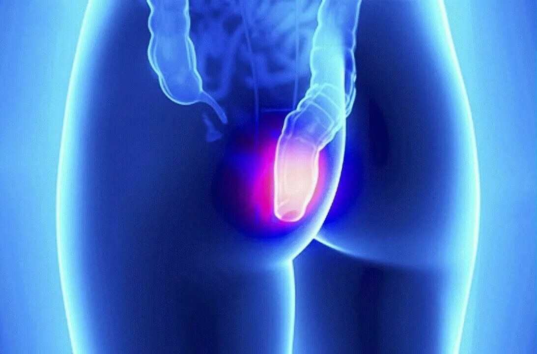 Атрезия прямой кишки классификация. Задний проход прямой кишки лечение. Латексное лигирование внутренних геморроидальных узлов. Задний проход прямой кишки лечение. Наружный геморроидальный узел большой.