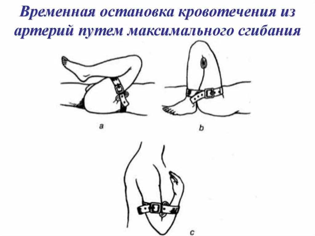 Остановка кровотечения путем сгибания конечности. Временная остановка кровотечения. Временная остановка кровотечения из артерии. Временный гемостаз сгибанием конечности. Остановка кровотечения из коленной артерии.
