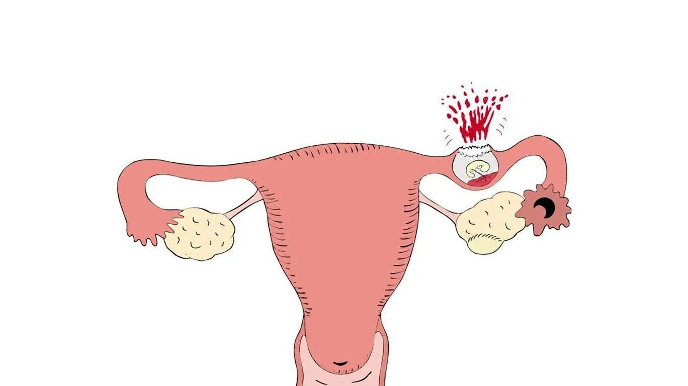 Почему происходит внематочная. Внематочная беременность разрыв маточной трубы. Внематочная беременность трубный разрыв. Внематочная (эктопическая) беременность. Патоморфология внематочной беременности.