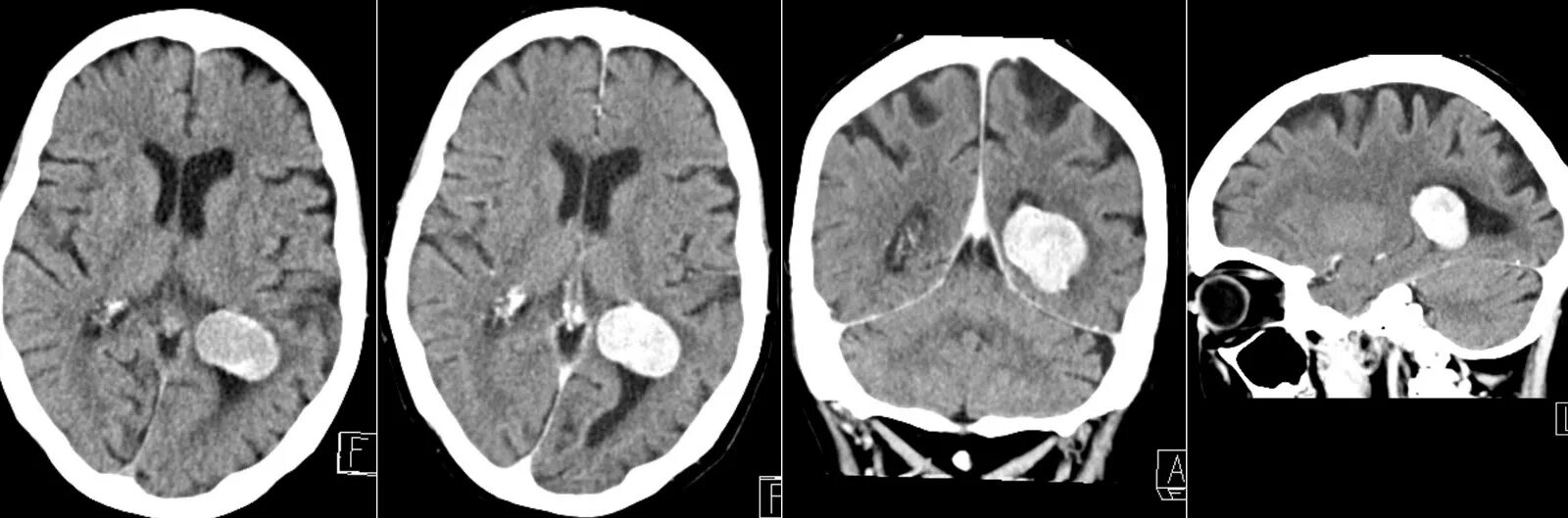 Боли при менингиоме. Менингиома доброкачественная. Боли при менингиоме. Менингиома желудочков мозга. Боли при менингиоме.