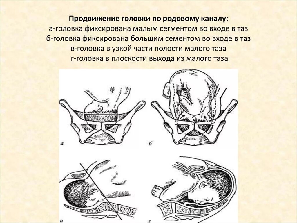 Признак пискачека. Оценка продвижения головки плода по родовому каналу. Головка плода малым сегментом во входе в малый таз. Продвижение головки по родовым путям. Головка большим сегментом во входе в малый таз.