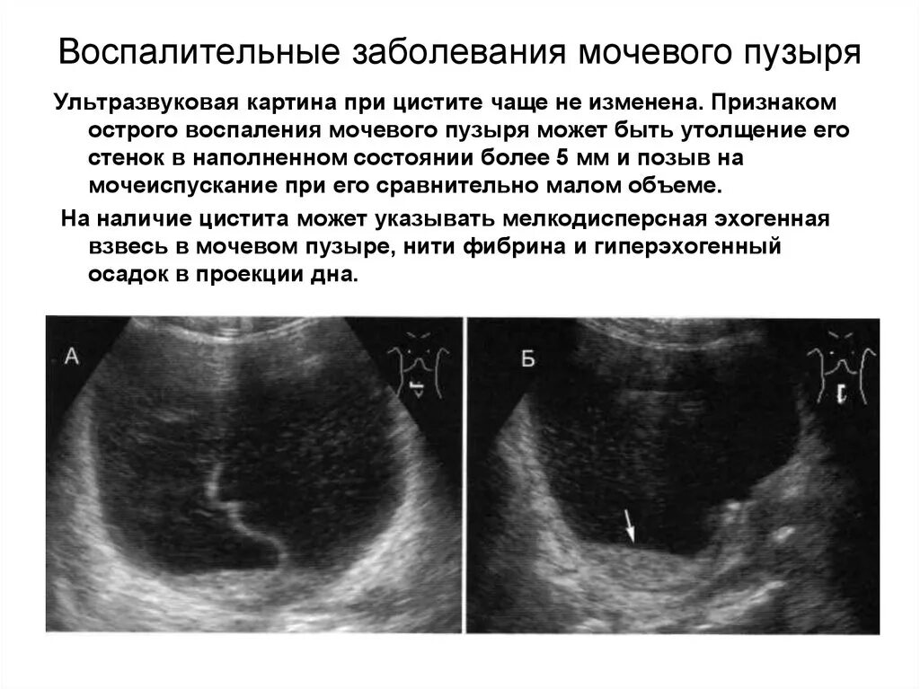 Хронический цистит на УЗИ описание. Стенки мочевого пузыря утолщены УЗИ. Воспаление мочевого пузыря на УЗИ. Взвесь в мочевом пузыре на УЗИ что это.