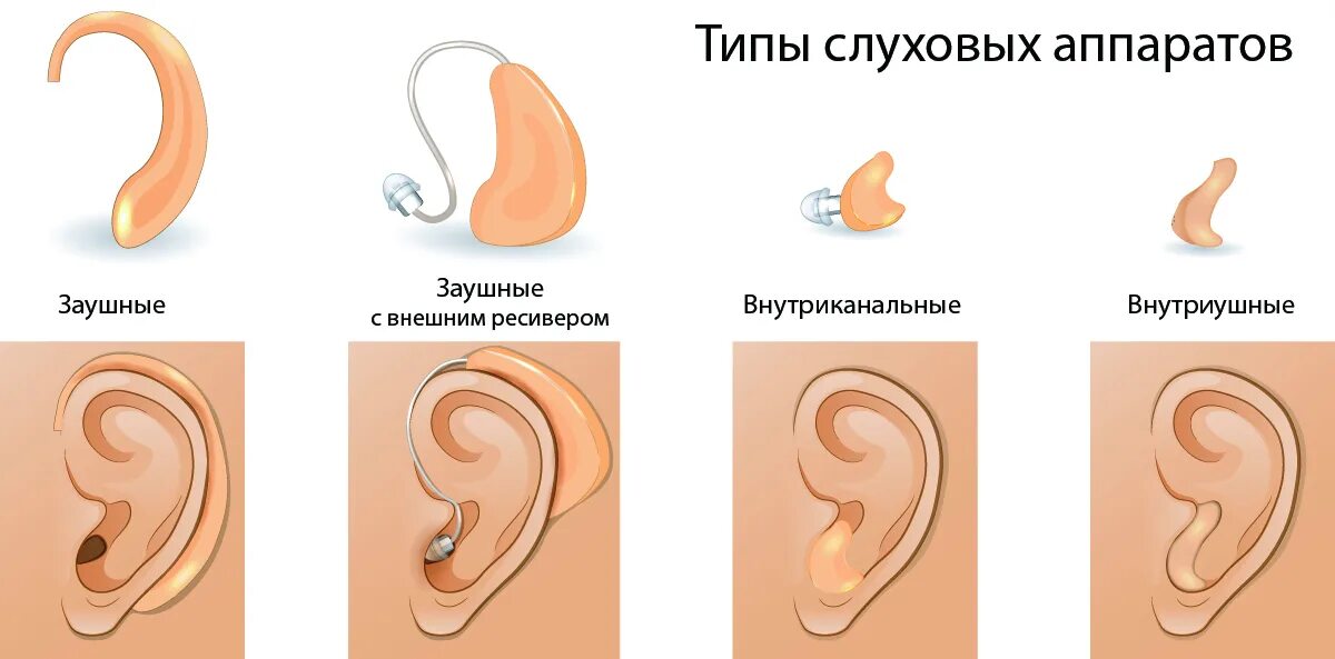 Внутриканальные слуховые аппараты(ITC). Слуховой аппарат BTE. Заушные слуховые аппараты (BTE). Классификация заушных слуховых аппаратов.