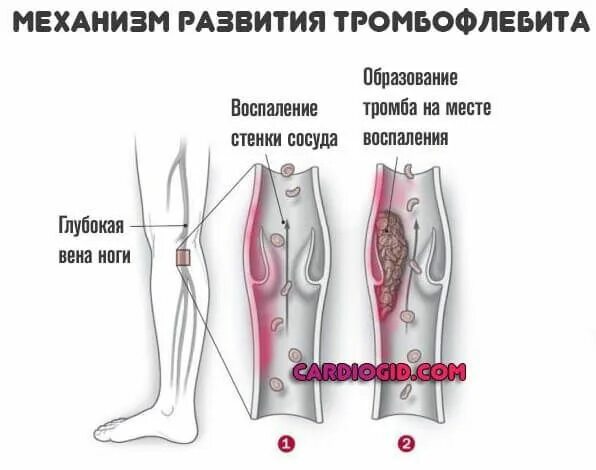 Температура при тромбе