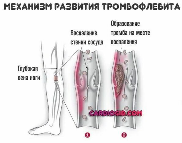 Тромбоз нижних конечностей лечение препараты. Тромбофлебит вен нижних конечностей препараты. Схема лечения тромбофлебита нижних конечностей. Препараты при тромбозе вен нижних конечностей. Тромбофлебит глубоких вен нижних конечностей.