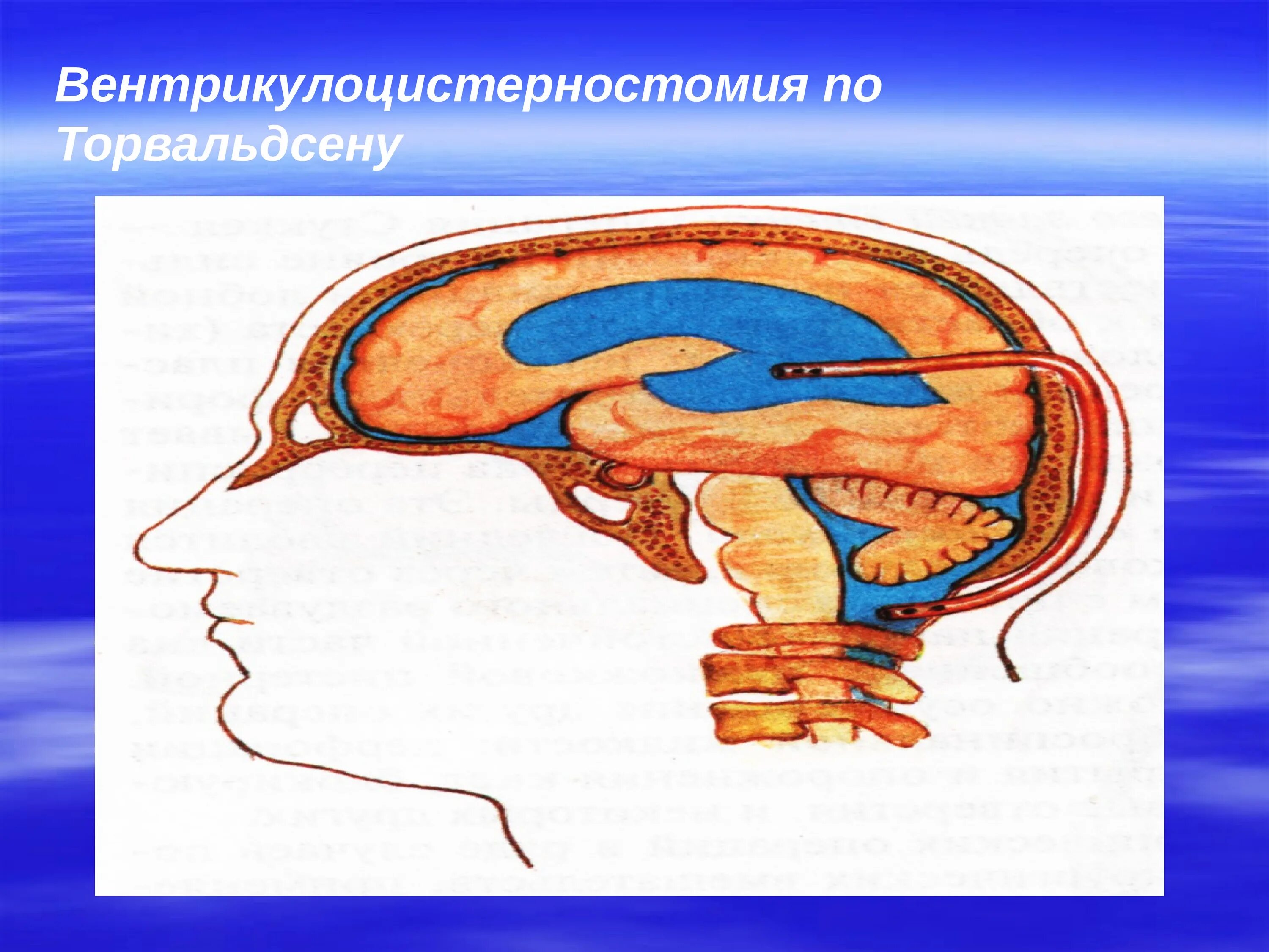 Головные шунты. Операция Торкильдсена вентрикулоцистерностомия. Торкильдсену операция. Эндоскопическая вентрикулоцистерностомия. Вентрикулоцистерностомия дна третьего желудочка.