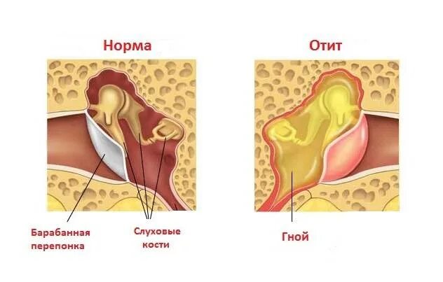 Отит внутреннего уха симптомы. Отит внутреннего уха симптомы