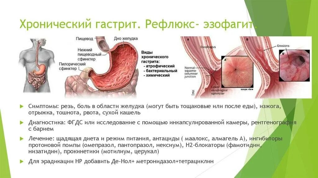 Эрозивный рефлюкс-эзофагит. Язвенный рефлюкс эзофагит. Профилактика хронического гастрита рефлюкс гастрита. Симптомы рефлюкса эзофагита. Боли в желудке лечение в домашних