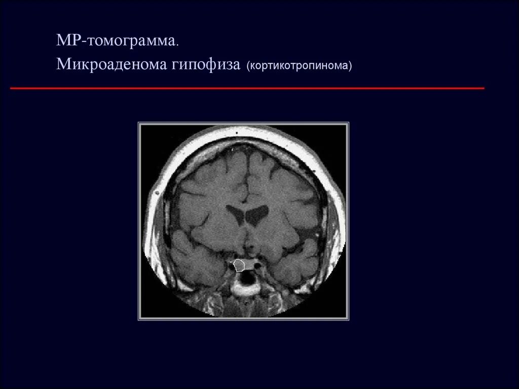 Опухоль гипофиза. Кортикотропная микроаденома гипофиза. Микроаденома гипофиза кт описание. Эндоселлярные аденомы гипофиза. Инфраселлярный рост аденомы гипофиза.