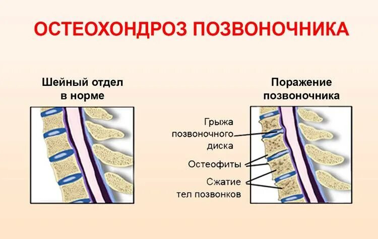 Панические атаки при остеохондрозе