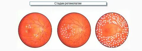 Диабетическая ретинопатия симптомы