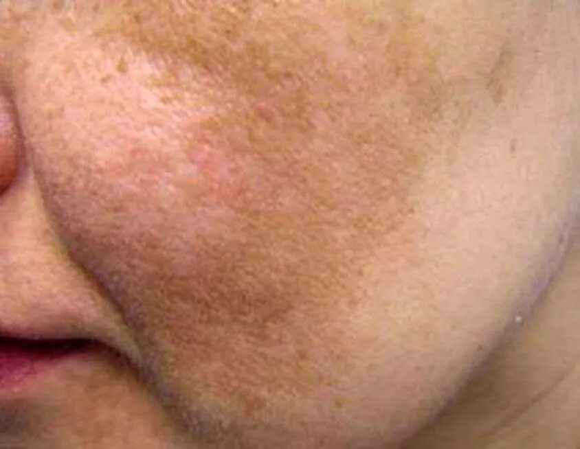 мелазма пигментные пятна. что говорят пятна на лице. меланиновая гиперпигментация. гиперпигментация мелазма. пигментация косметология.