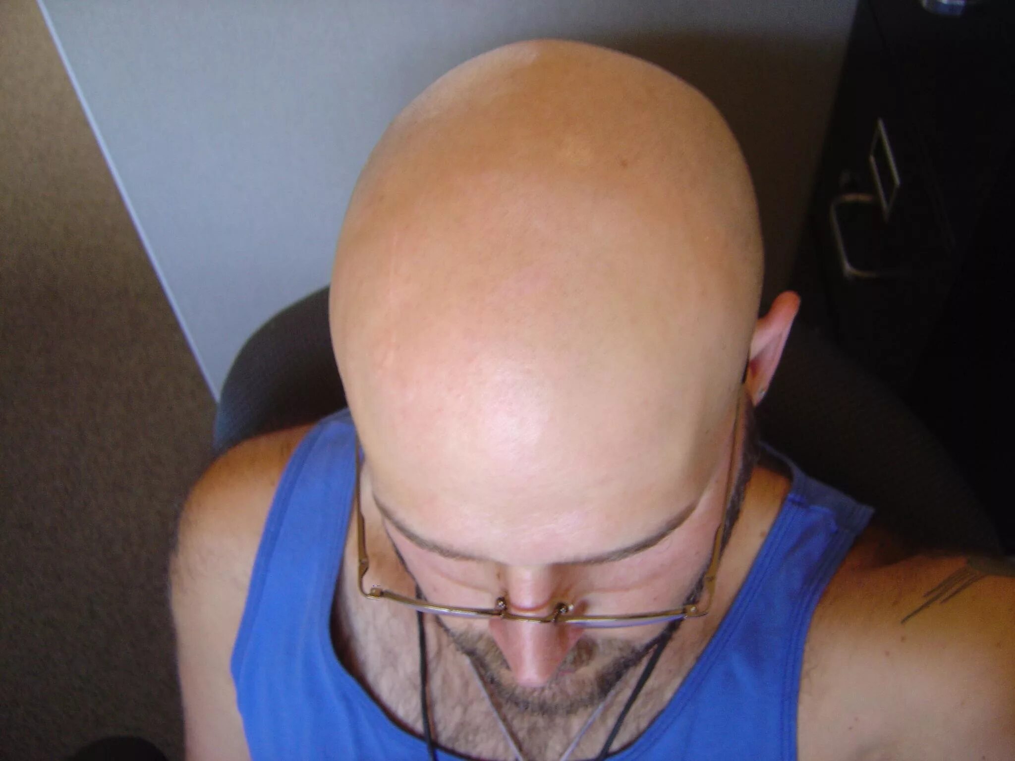 Лысая голова. Лысина сверху. Прически с лысиной на затылке. Прически с лысиной на затылке. Лысина посередине головы.