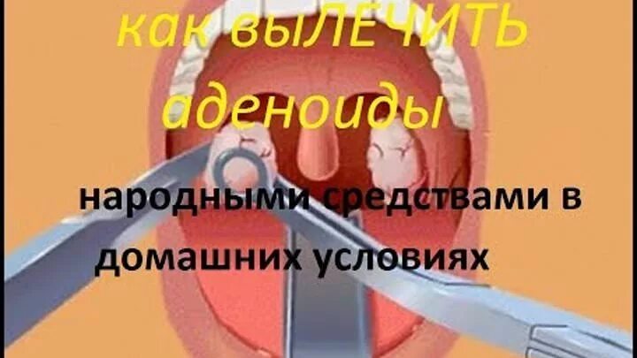 Можно вылечить аденоиды без операции у ребенка. Аденоиды у детей доктор комаровский. аденоиды у детей доктор евдокименко. аденоиды у детей лечение народной медициной. аденоиды у ребенка доктор комаровский как лечить.