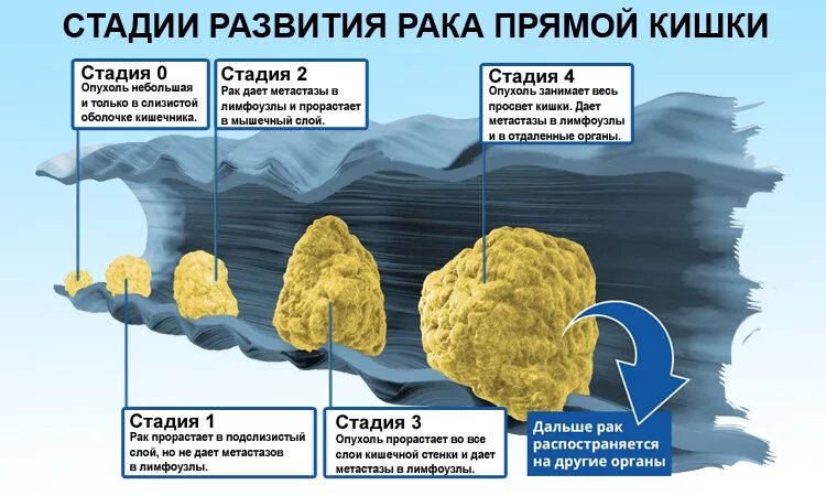 Стадии развития раковых. Стадии онкологического процесса. Стадии развития опухоли. Стадии опухолевого процесса.