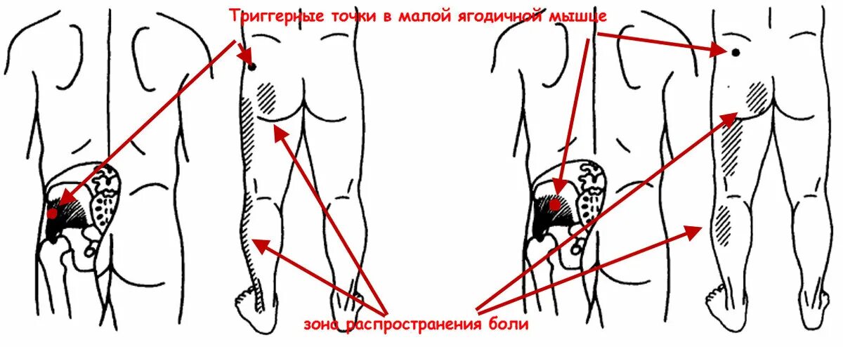 Боли ниже поясницы отдающие в ноги. Триггерные точки ягодичной мышцы.