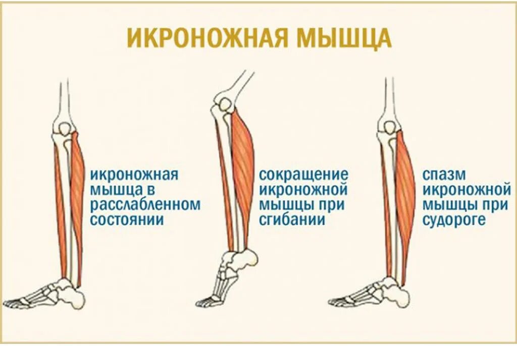 Почему часто сводит ноги. Спазм в мышцах икроножных судороги. Судорожное сокращение мышц. Спазмируются икроножные мышцы.