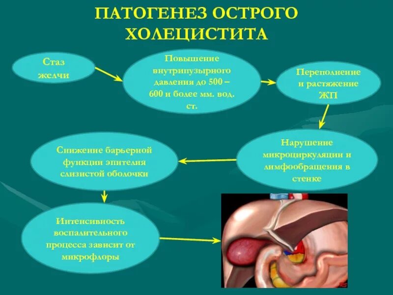 Хронический холецистит гастрит. Механизм развития острого холецистита. Патогенез ЖКБ острый холецистит. Патогенез хронического холецистита кратко. Острый и хронический холецистит патогенез.