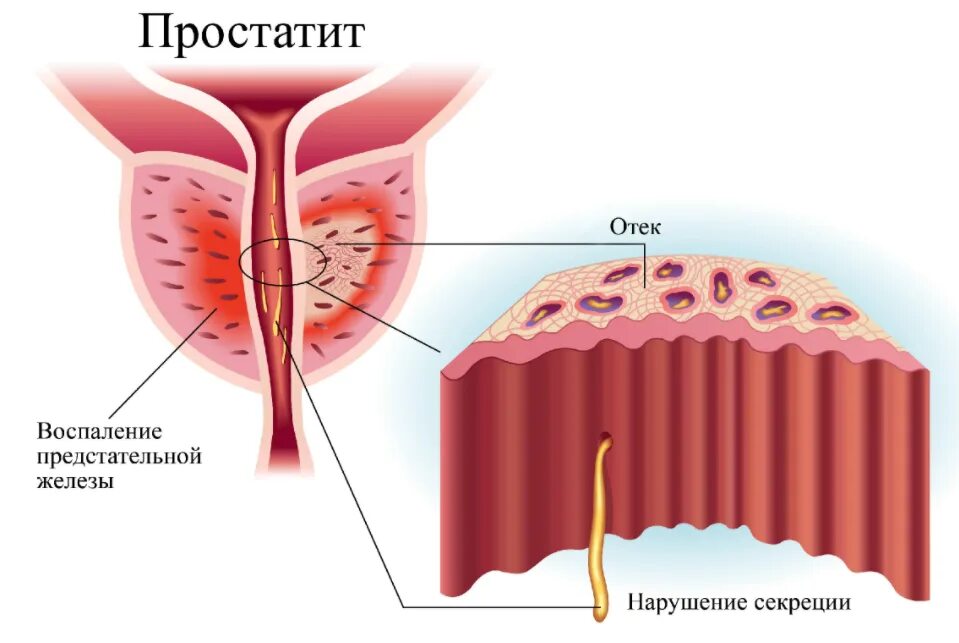 Воспалился простатит. Воспаление в предстательной железе. Воспалительный процесс в предстательной железе. Воспалительные заболевания предстательной железы.