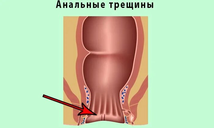 Трешиныв заднем проходе. Трещина в заднем проходе у ребенка.