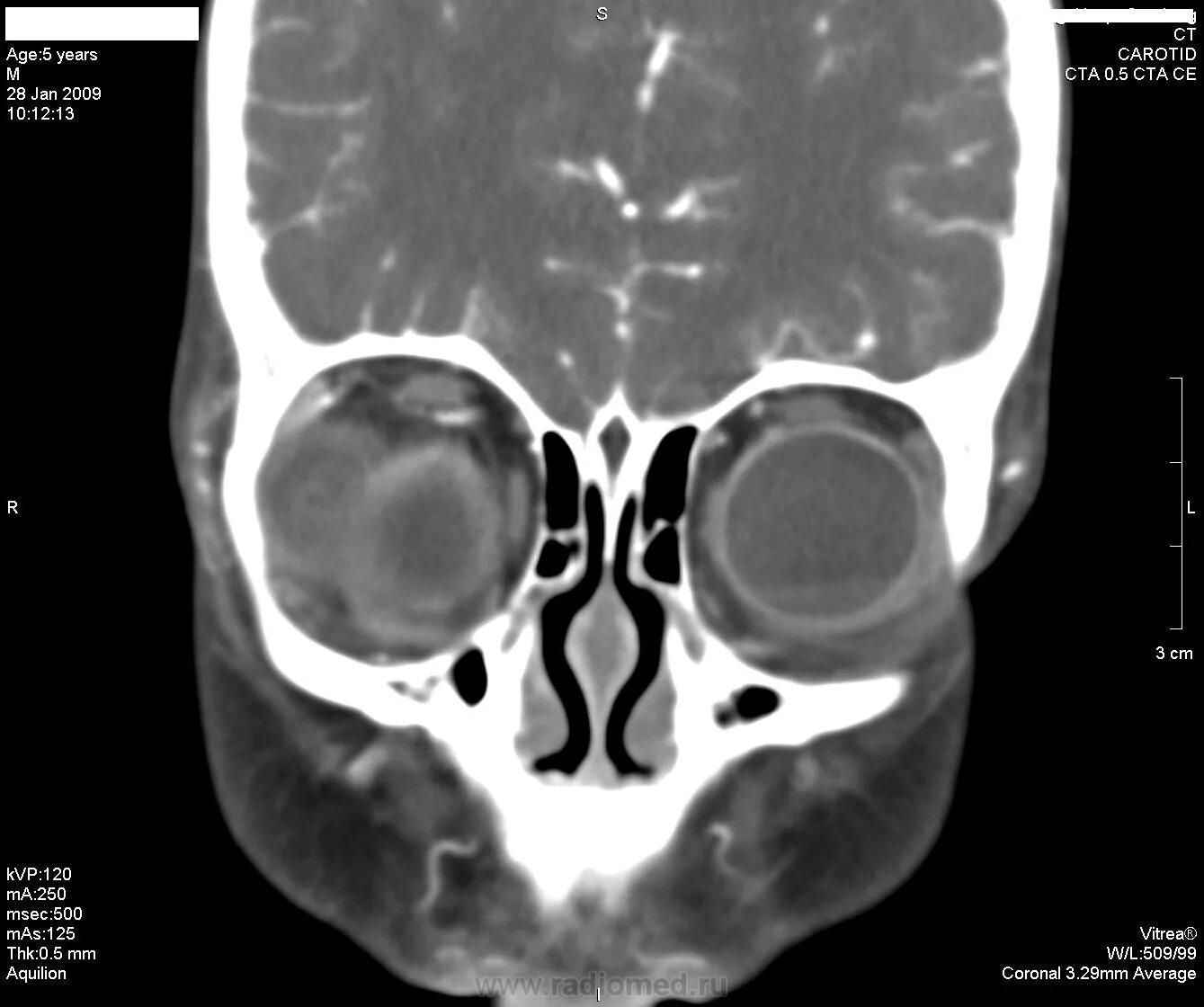 Кт глазницы и кт орбиты. Метастатические опухоли орбиты. Анатомия орбиты на кт. Опухоль глазных орбит на мрт. Опухоли орбиты