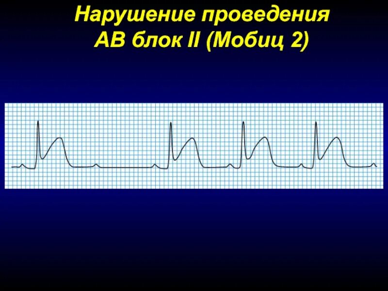 АВ блокада Мобиц 2. Мобиц. Мобиц 1. Мобиц 1 и Мобиц 2. Av блок