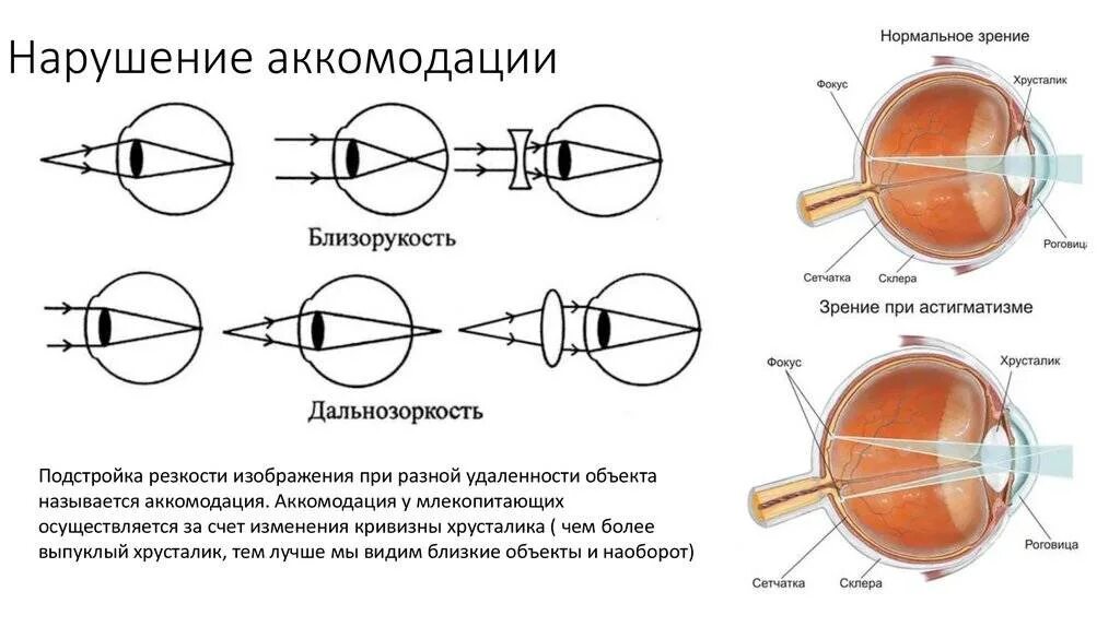 Операция при дальнозоркости. Аккомодация при миопии. Аккомодационный аппарат глаза при миопии и гиперметропии. Нарушения аккомодации зрительного анализатора.. Близорукость и дальнозоркость нарушение аккомодации.