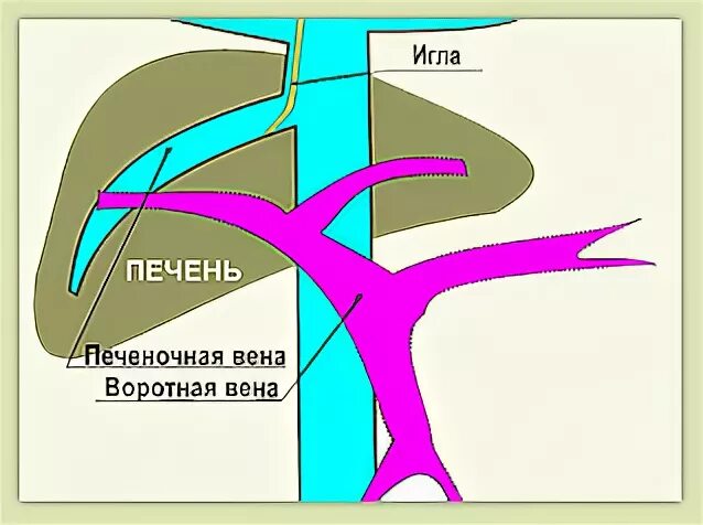 Печень расширены вены. Портальная Вена печени. Варикозное расширение воротной вены. Схема движения крови воротной вены печени.