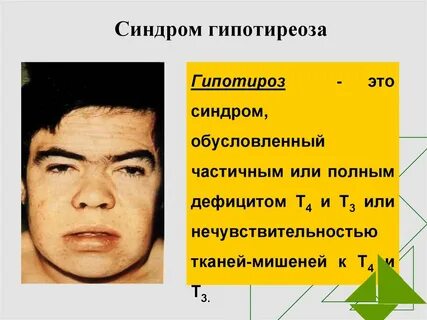 Гипотиреоз ноги
