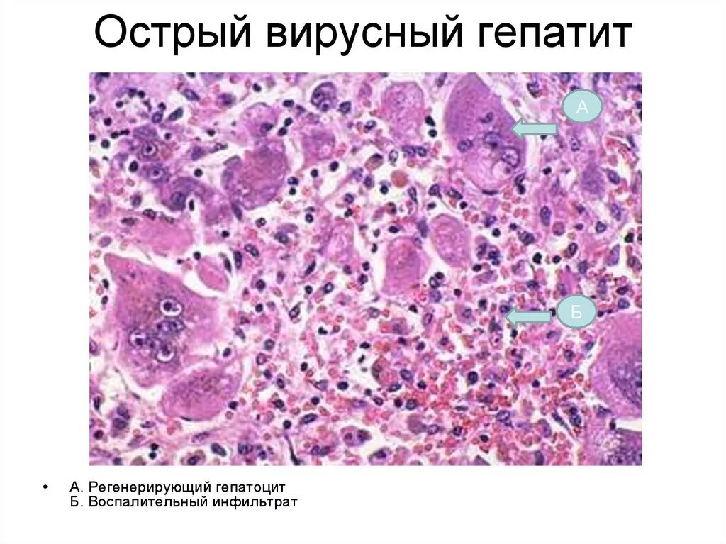 Вирусный гепатит гистология. Острый гепатит микропрепарат. Острый гепатит гистология. Вирусный гепатит острая циклическая форма микропрепарат.