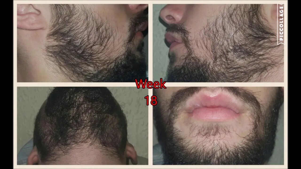 Миноксидил для бороды Прогресс. Миноксидил этапы роста бороды. Борода жидкая миноксидил. Minox Minoxidil 7%. Через сколько после бритья
