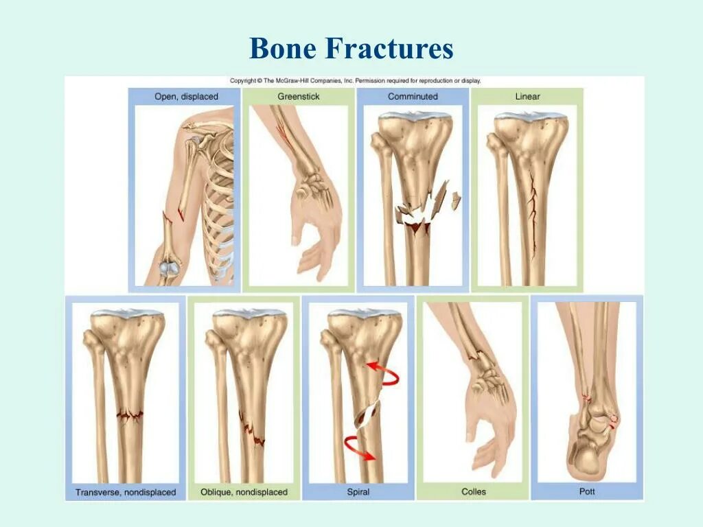 Перелом кости может быть каким. Классификация переломов костей. Самые частые переломы костей.