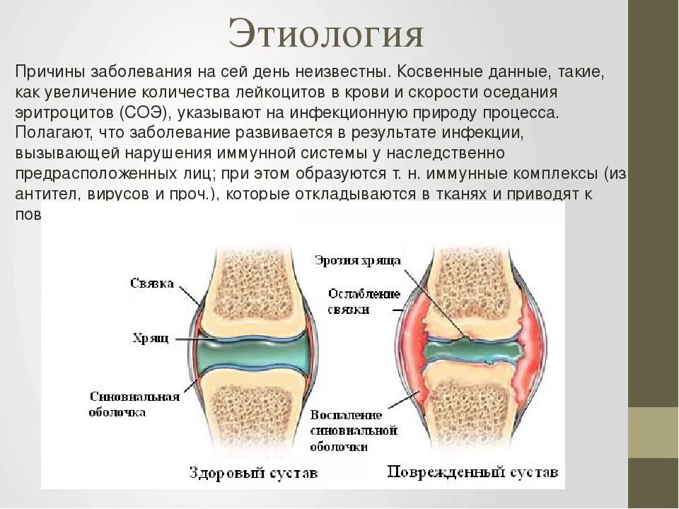 Изменение суставного хряща