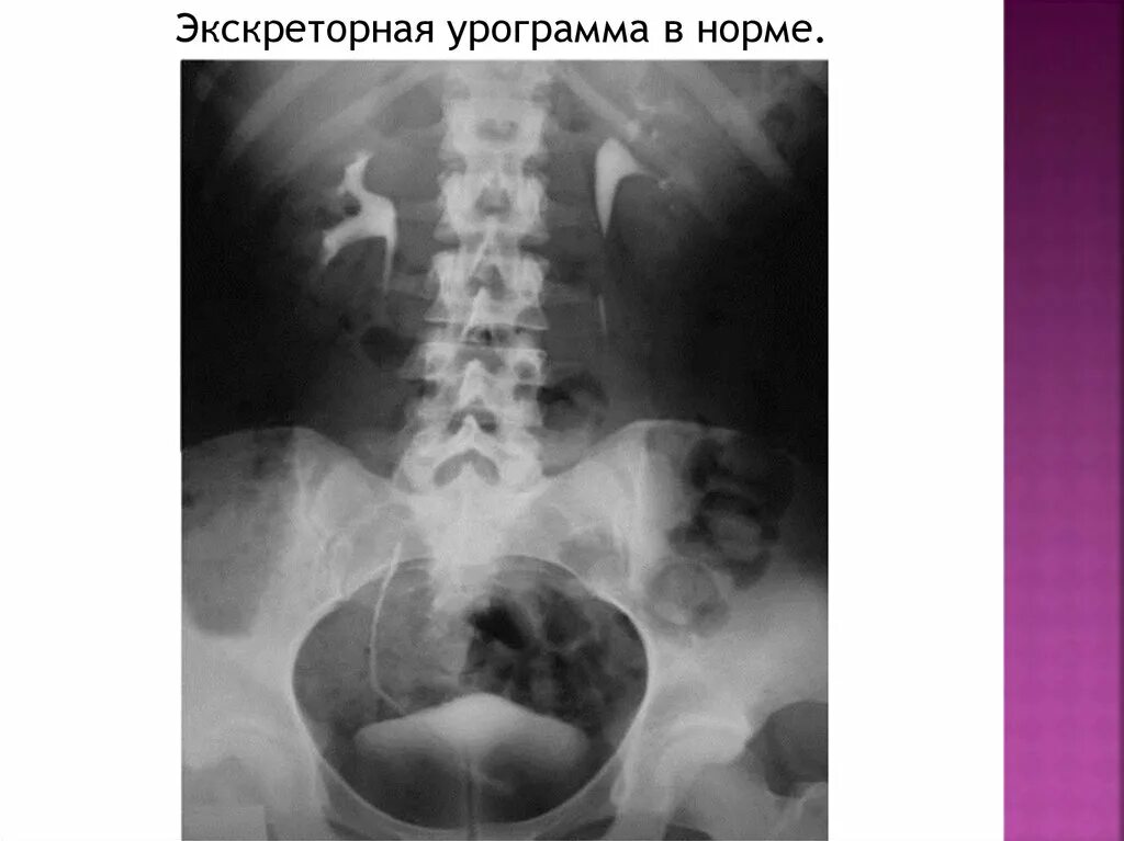 Урография с контрастом. Внутривенная урография гидронефроз. обзорная и экскреторная урография. рентгеноконтрастная урография. обзорная урограмма норма.