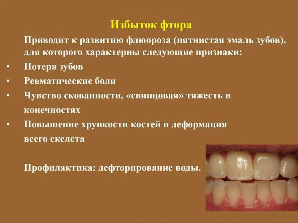 Системная гипоплазия эмали зубов у детей. Гипоплазия эмали гипоплазия флюороз. Избыток фтора в организме.